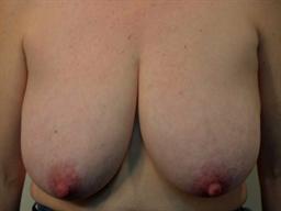 Front of breasts before surgery