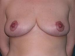 Front of breasts after surgery