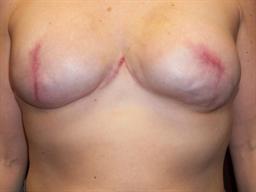 Front of breasts after surgery