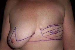 Front of breasts before surgery