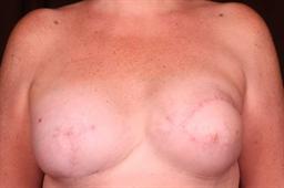 Front of breasts after surgery