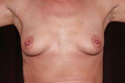 Front of breasts before surgery