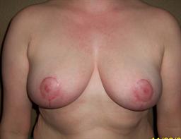 Front of breasts after surgery