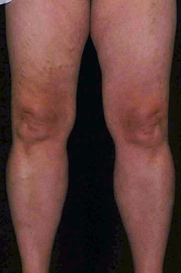 Front of legs before treatment