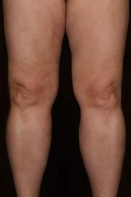 Front of legs after treatment