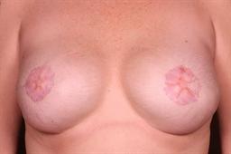 Front of breasts before surgery