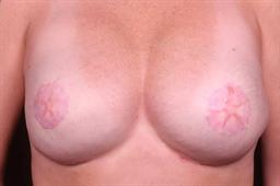 Front of breasts after surgery