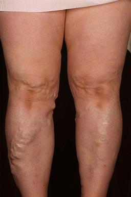 Front of legs before treatment