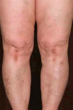 Front of legs after treatment