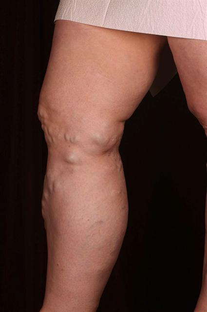 Inside Right Leg Before