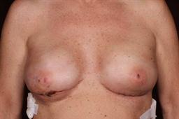 2 wks. post op bilateral mastectomy w/tissue expanders