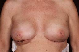 Front of breasts after surgery