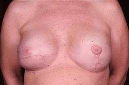 1 mo. post op mastopexy lift on left, revision on rt