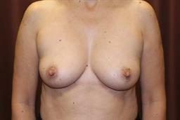 Front of breasts before surgery