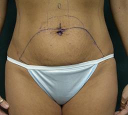 Front of abdomen before surgery