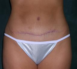 Front of abdomen after surgery