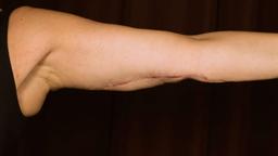 Front left arm after surgery