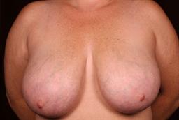 Front of breasts before surgery