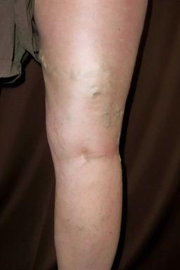Back of legs before treatment