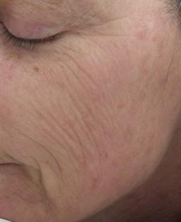 Left side of face before treatment