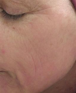 Left side of face after treatment