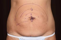 Front of abdomen before surgery