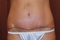 Front of abdomen after surgery