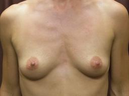 Front of breasts before surgery