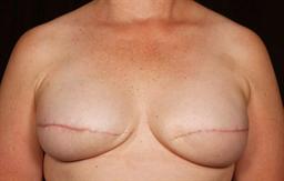 Front of breasts after surgery