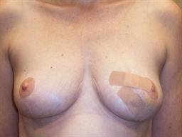 Front of breasts before surgery