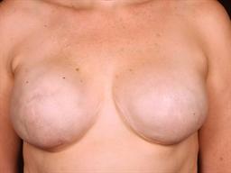 Front of breasts after surgery