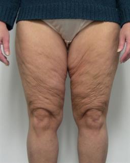 Front of thighs before thigh lift