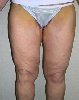 Front of thighs after thigh lift