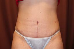 Front of abdomen after surgery