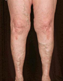 Front of legs before treatment