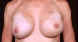 Front of breasts after surgery