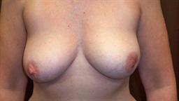 Front of breasts before surgery