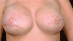 Front of breasts after surgery