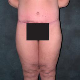 Fox Valley Plastic Surgery  Body Lift Surgery (Lipectomy)