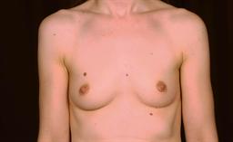 Front of breasts before surgery