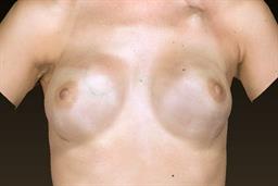 Front of breasts after surgery