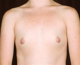 Front of breasts before surgery