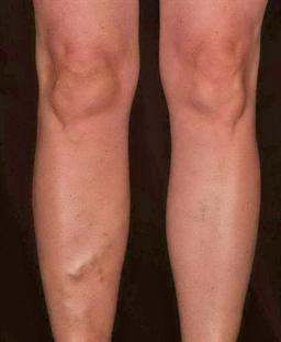 Front of legs before treatment