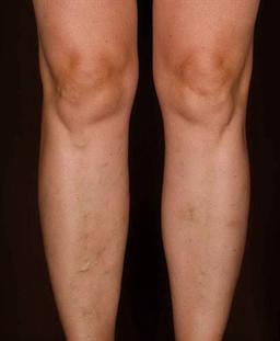 Front of legs after treatment