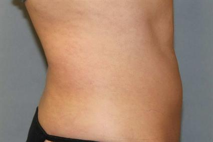 After 7 wks.