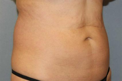 After 7 wks.