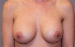 Front of breasts after surgery