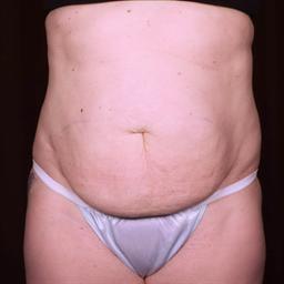 Front of abdomen before surgery