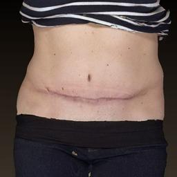 Front of abdomen after surgery