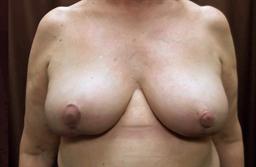 Front of breasts after surgery